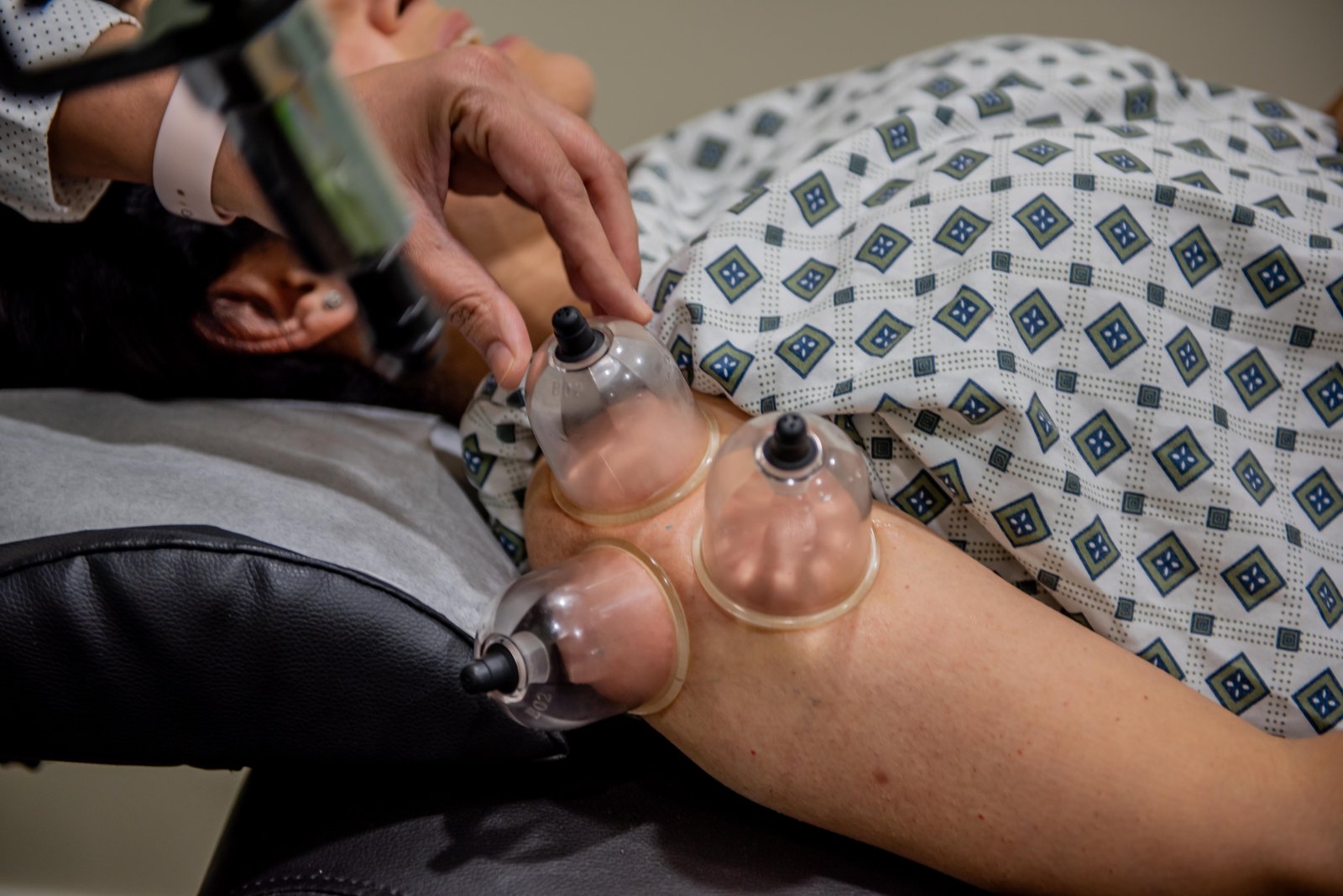 Dry Cupping Therapy